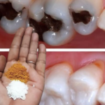 Remède naturel dent mobile