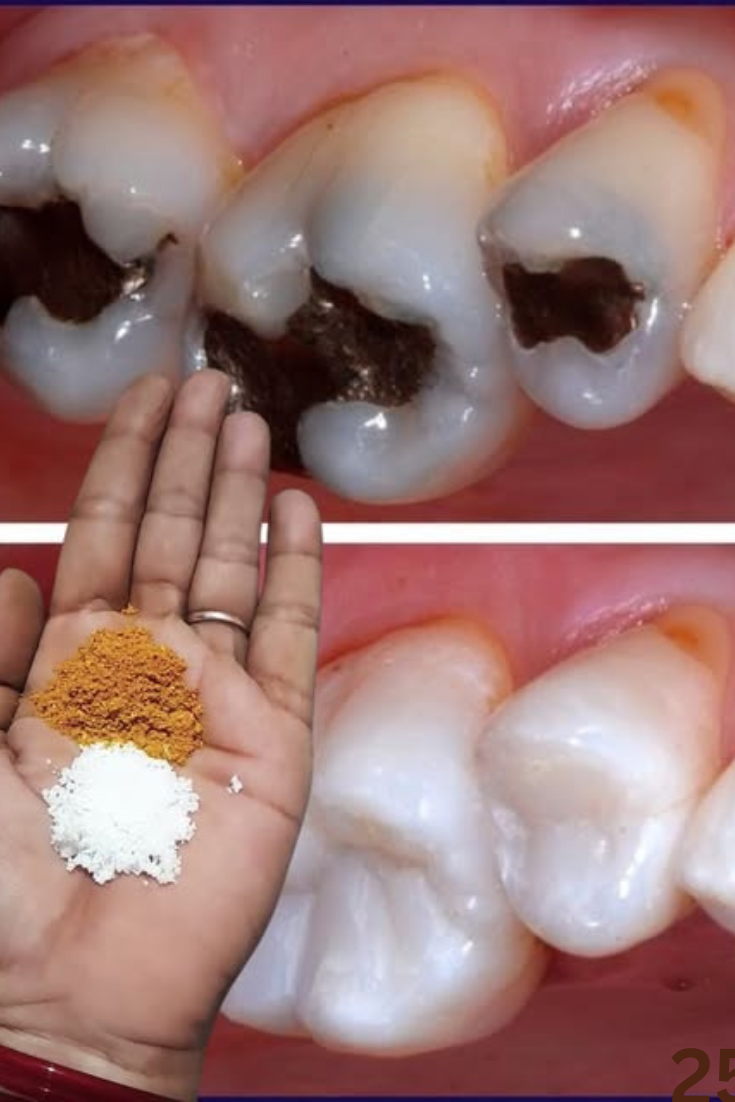 Remède naturel dent mobile