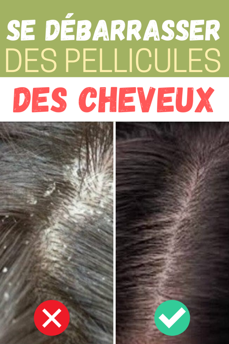 remède naturel contre pellicules