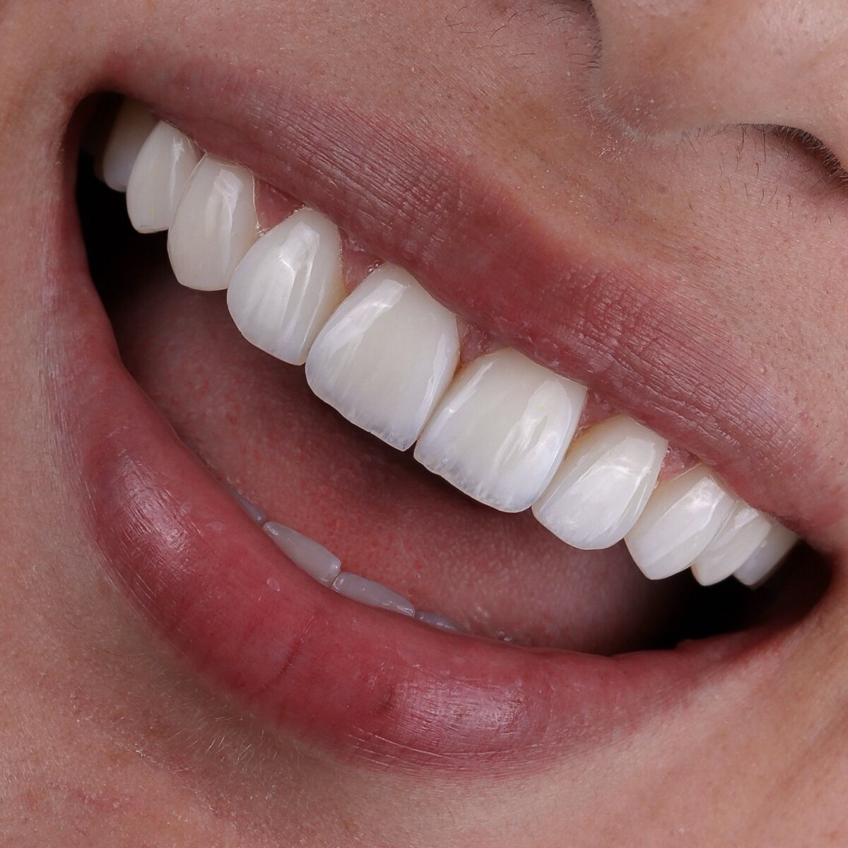 avantages prothèse dentaire santé