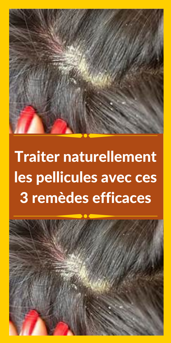 traitement naturel pellicules cheveux