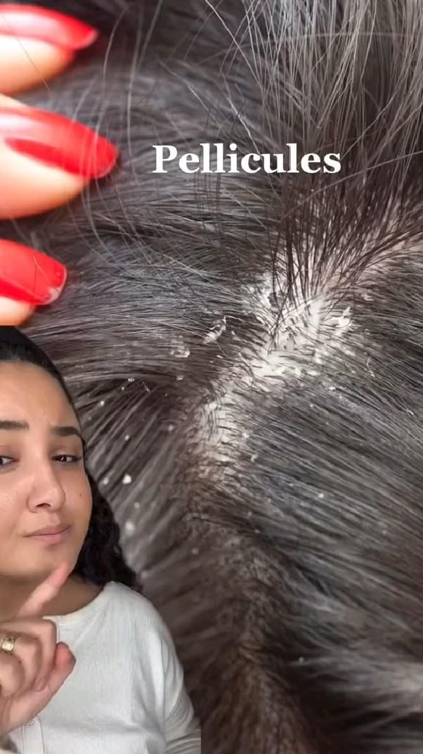 traitement naturel pellicules cheveux