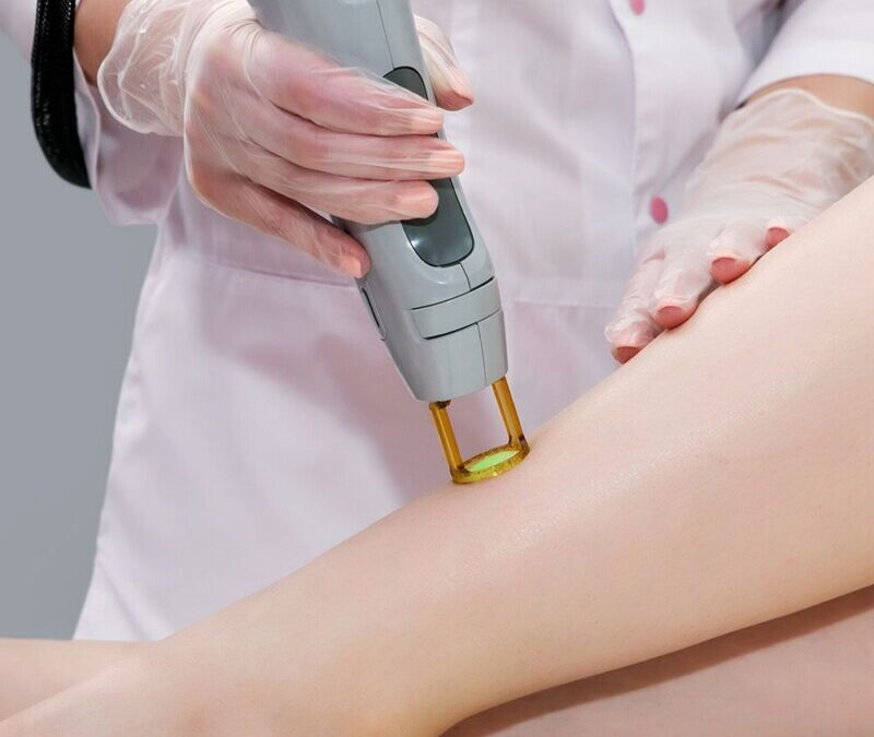 Épilation laser : à quoi s’attendre séance après séance