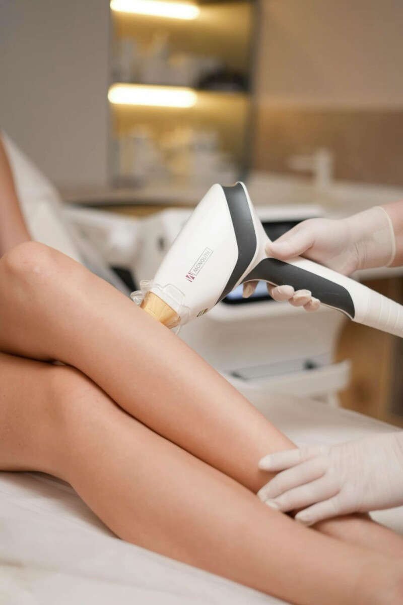 epilation laser