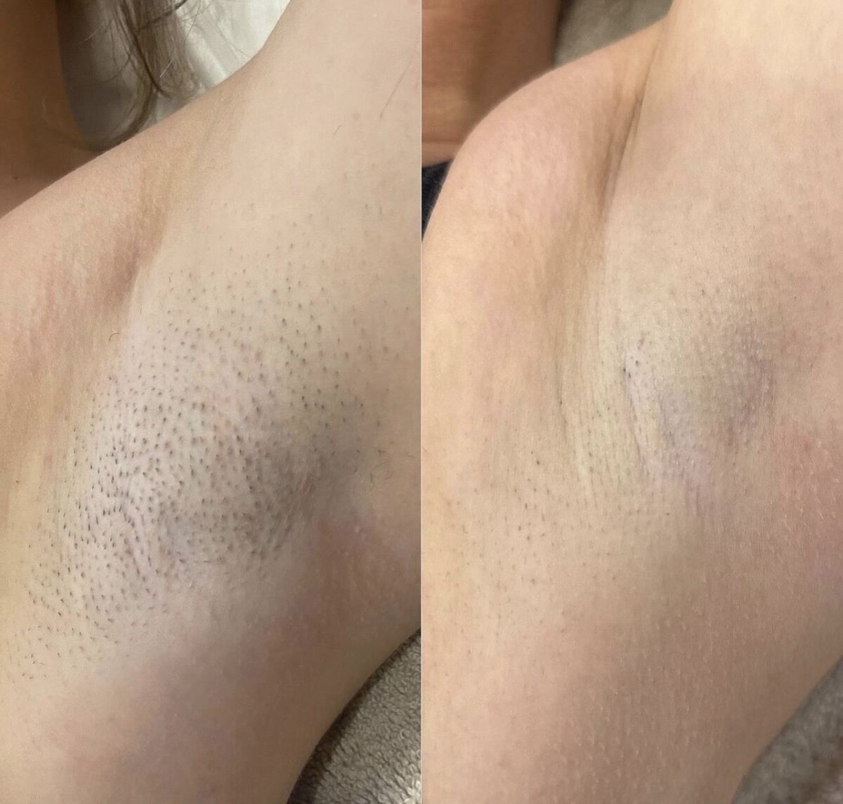 epilation laser attendre
